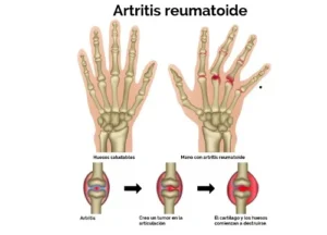 ARTRITIS REUMATOIDE DESAHUCIADA TESTIMONIO REPLICADO POR LA DRA BLANCA BOLAÑOS DESDE LA ASOCIACION MUNDIAL.