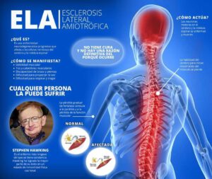 TESTIMONIO ESCLEROSIS LATERAL AMIOTRÓFICA (ELA) INCURABLE SE CURÓ PRECISAMENTE CON EL DECLARADO MEDICAMENTO HUÉRFANO.