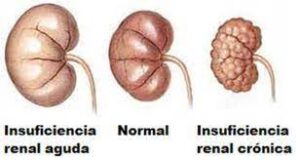 INSUFICIENCIA RENAL TESTIMONIO POR LA ASOCIACIÓN MUNDIAL, RESPONDE ANDREAS KALCKER