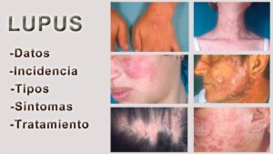 TESTIMONIO DE LUPUS DESAHUCIADO REPLICADO POR LA DRA BLANCA BOLAÑO. POR LA ASOCIACIÓN MUNDIAL. EL CDS.