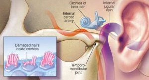 ACÚFENOS, TINNITUS POR LA DR BLANCA BOLAÑO DESDE LA COALICIÓN MUNDIAL