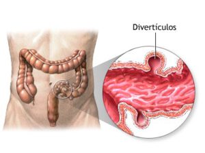 DIVERTICULOSIS TESTIMONIO, REPLICADO POR LA DRA BLANCA BOLAÑO DESDE LA ASOCIACIÓN MUNDIAL.