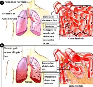 ¿FIBROSIS PULMONAR?….Y POST COVID? LA EMINENCIA DR INSIGNARES DESDE LA ASOCIACION MUNDIAL RESPONDE