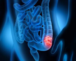 LA DRA BLANCA BOLAÑO DESDE BOLIVIA Y POR LA ASOCIACIÓN MUNDIAL ANTE EL TESTIMONIO DE CANCER DE COLON. EL CDS.