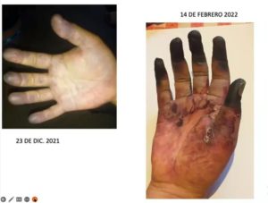 EL DR EDUARDO CACERES NOS HABLA UN POCO DEL DMSO Y DEL CDS Y NOS PRESENTA UNA CASO DE TROMBOSIS DE MIEMBRO SUPERIOR DERECHO (IMAGENES NO APTAS PARA TODOS LOS PUBLICOS)