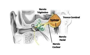 ¡¡ DE LOCOS !! 2 GOTAS DE DMSO Y EMPIEZA A OIR …CON TUMOR EN EL OIDO.
