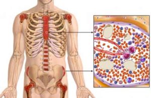 IMPRESIONANTE CASO DE MAL FUNCIONAMIENTO DE LA MEDULA OSEA PARA PRODUCIR GLOBULOS BLANCOS Y ROJOS RECUPERANDOSE CON DMSO, CDS, AGUA DE MAR Y OTRO. POR EL DR EDUARDO CACERES