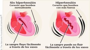 LA HIPERTENSION Y EL DMSO (DIMETILSULFOXIDO) POR EL DR EDUARDO CACERES