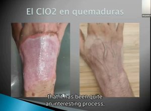 QUEMADURA CON ACEITE A 500º CURADO CON CDS. TESTIMONIO