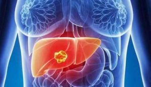 CANCER DE HÍGADO Y DE PÁNCREAS CURADO CON CDS. CÓMO ES POSIBLE