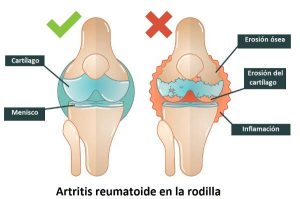 TESTIMONIO. PROTOCOLO ARTRITIS CRONICA TRATADO CON CDS Y DEMÁS.