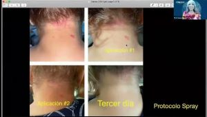 CASOS PROTOCOLO DERMATOLOGICO TRATADOS CON CDS, TESTIMONIOS.