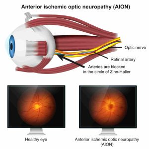 OSTEOMELITIS, NEURITIS OPTICA Y FIBROSIS PULMONAR FAMILIAR CURADO CON CDS ¿PERO ESTAS INVESTIGACIONES HACIA DONDE VAN?
