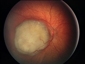 TUMOR EN MACULA EN OJO CURADO CON CDS. ¿ES ESTO POSIBLE? TESTIMONIO