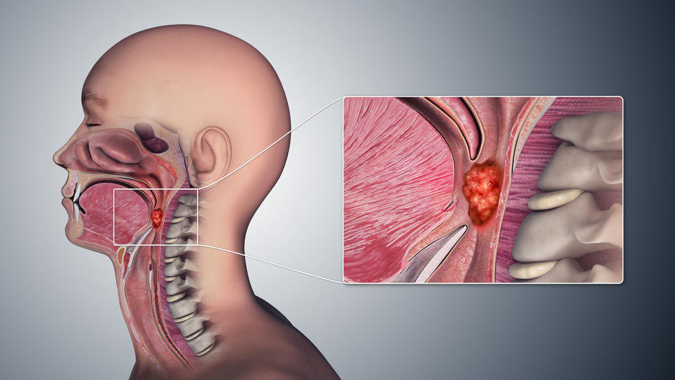 TESTIMONIO. CANCER OROFARINGE CURADO CON CDS