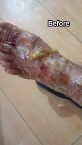 QUEMADURA DE TERCER GRADO CURADO CON CDS Y DMSO.