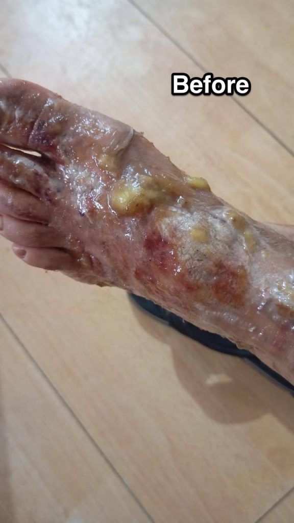 QUEMADURA DE TERCER GRADO CURADO CON CDS Y DMSO.