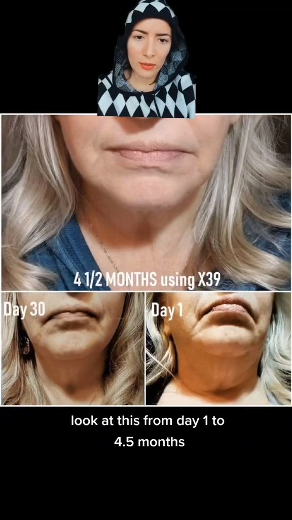 POPURRI DE CASOS DE REJUVENECER EL ANTES Y EL DESPUES CON LIFEWAVE